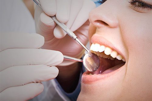 It’s Time For Dental Sealants In Punta Gorda FL