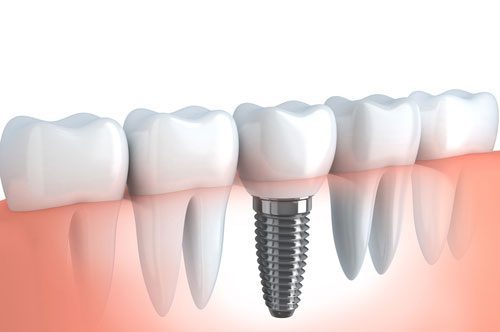 Do You Know The Benefits Of Dental Implants? [Infographic]