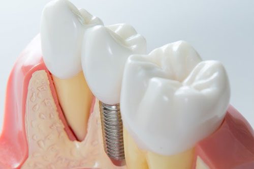 Dental Implants: The Long-Term Tooth Replacement [Quiz]
