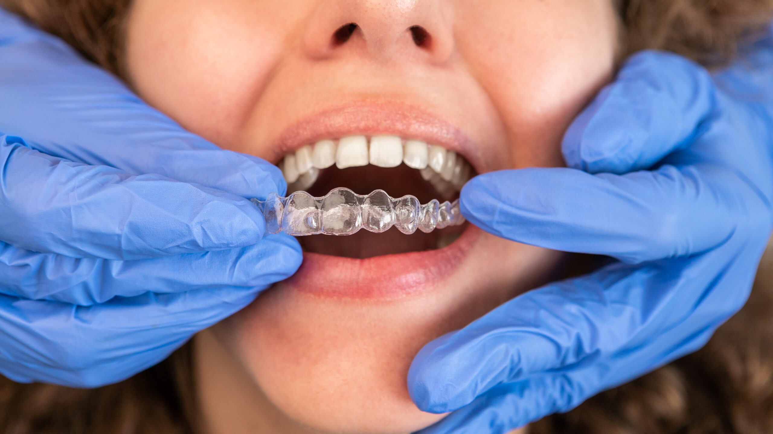 can invisalign fix overbite?