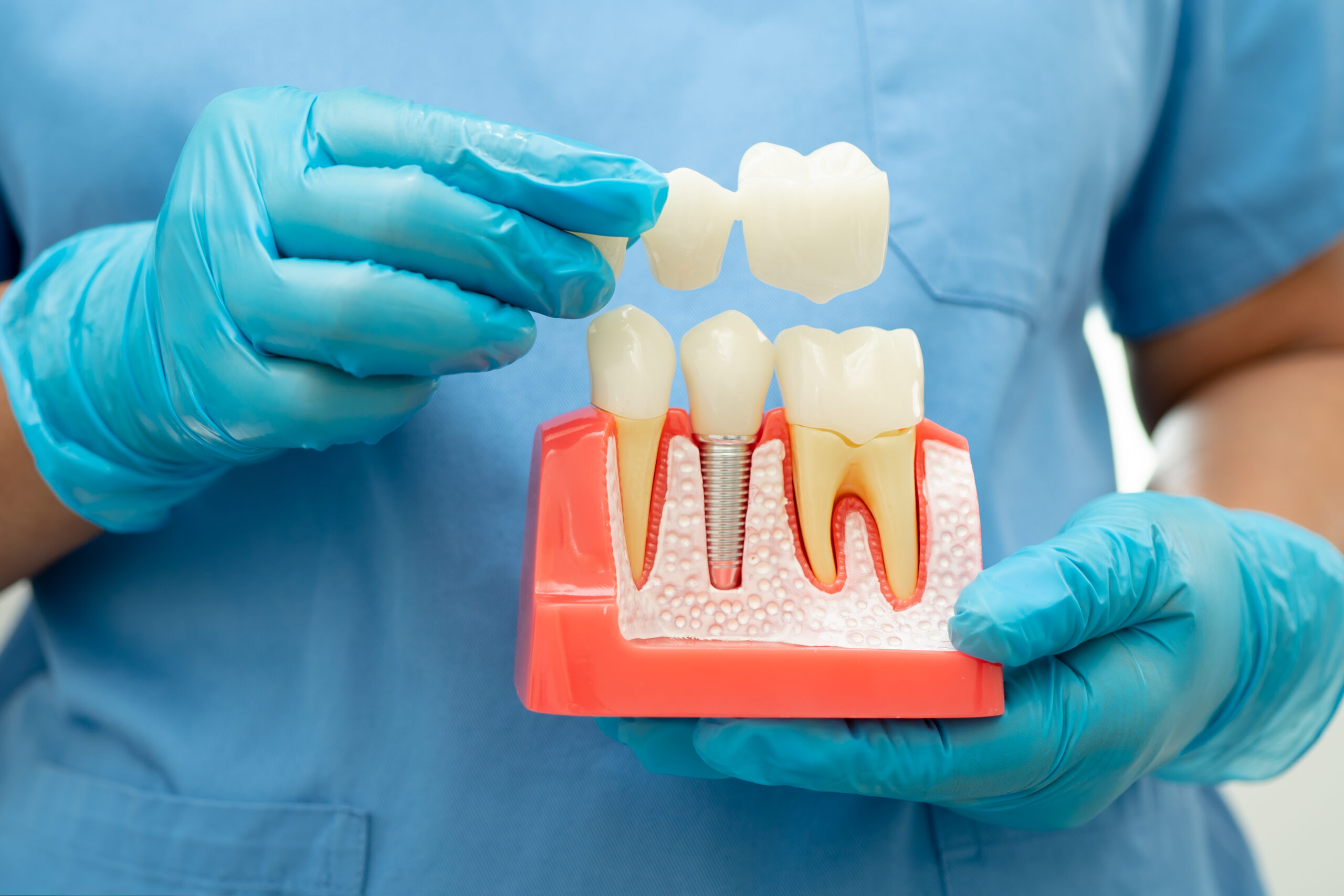 Benefits of Dental Implants: Restoring Your Smile and Confidence