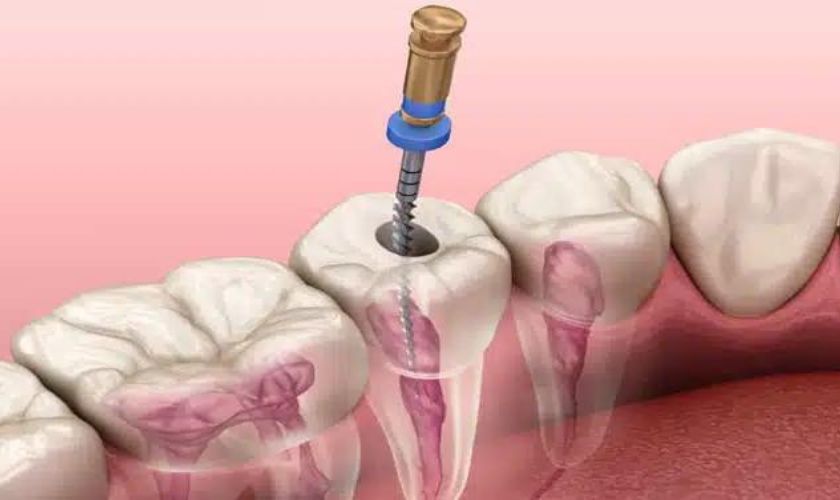 The Benefits of Root Canal Treatment in Smiles of Punta Gorda
