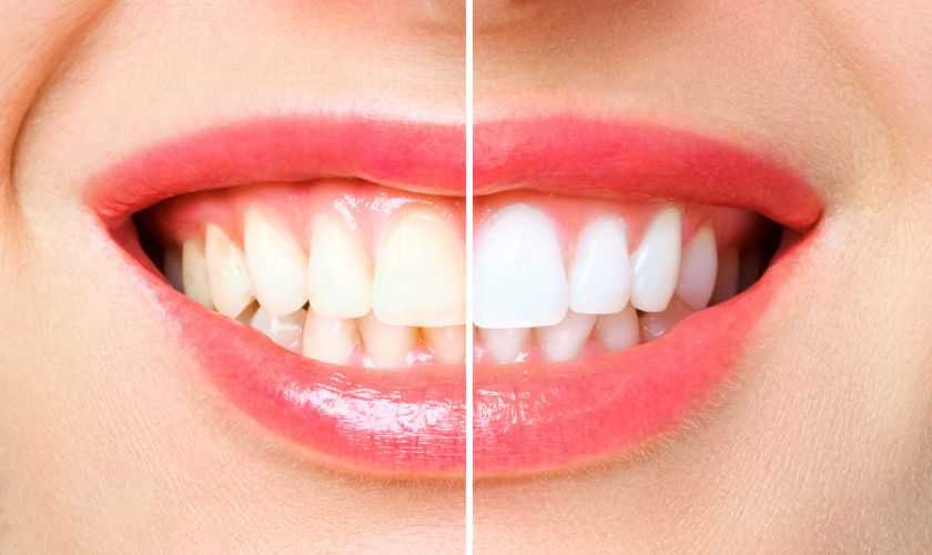 Teeth Whitening for Smokers: Removing Tough Tobacco Stains