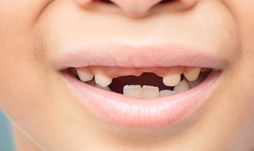 How to Repair Chipped, Cracked or Discolored Teeth with Dental Bonding?
