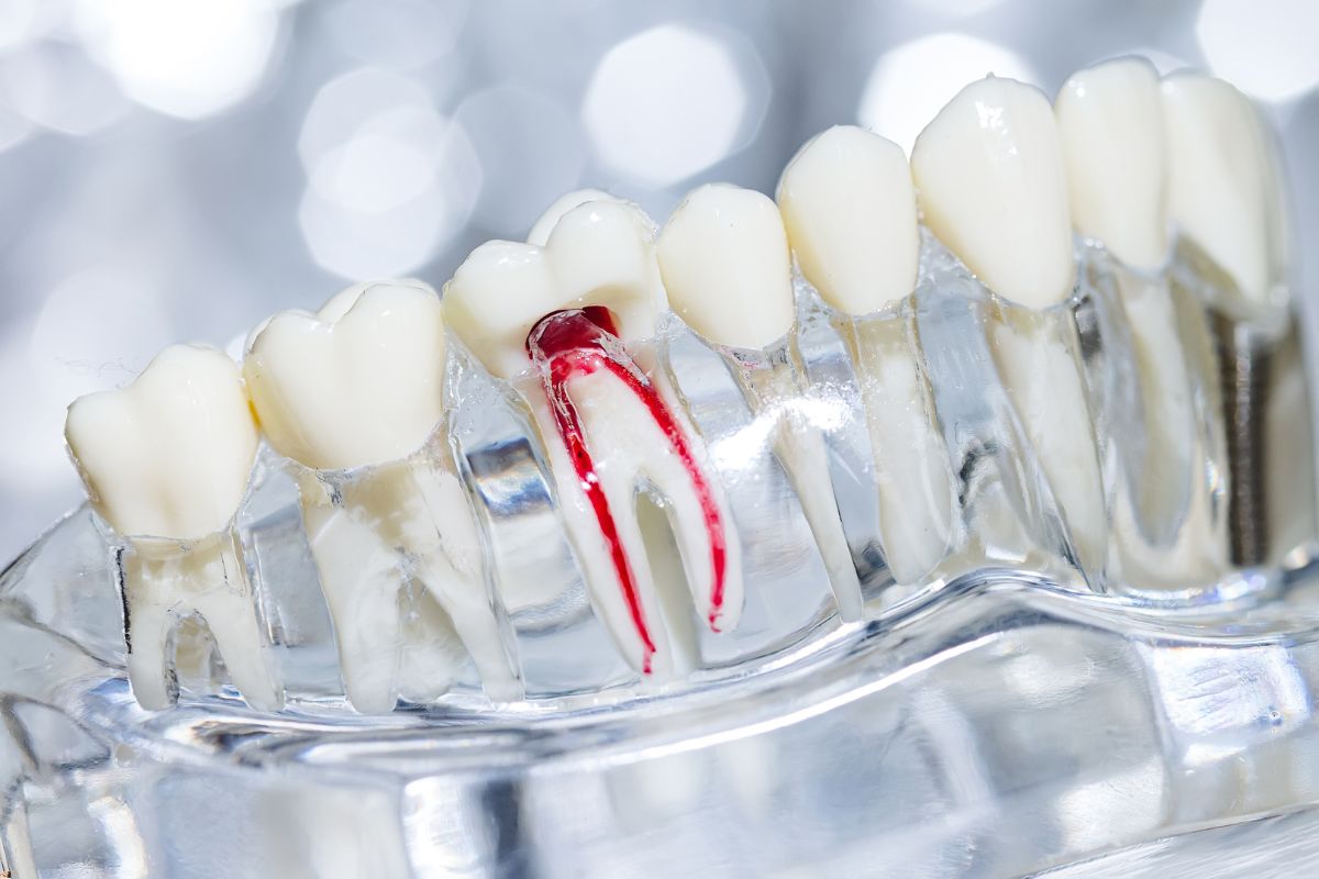 Does Root Canal Treatment Last Forever? Unlocking the Secrets of Long-Term Success