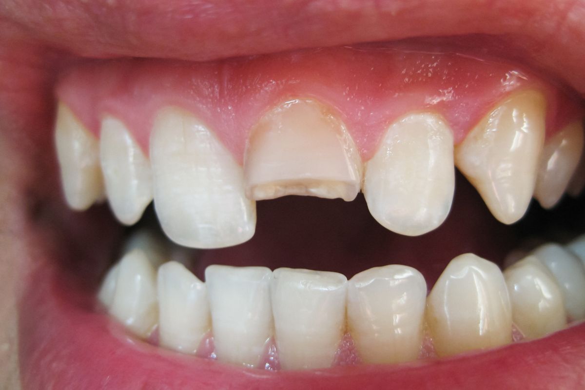 Can a Cracked Tooth Be Fixed?