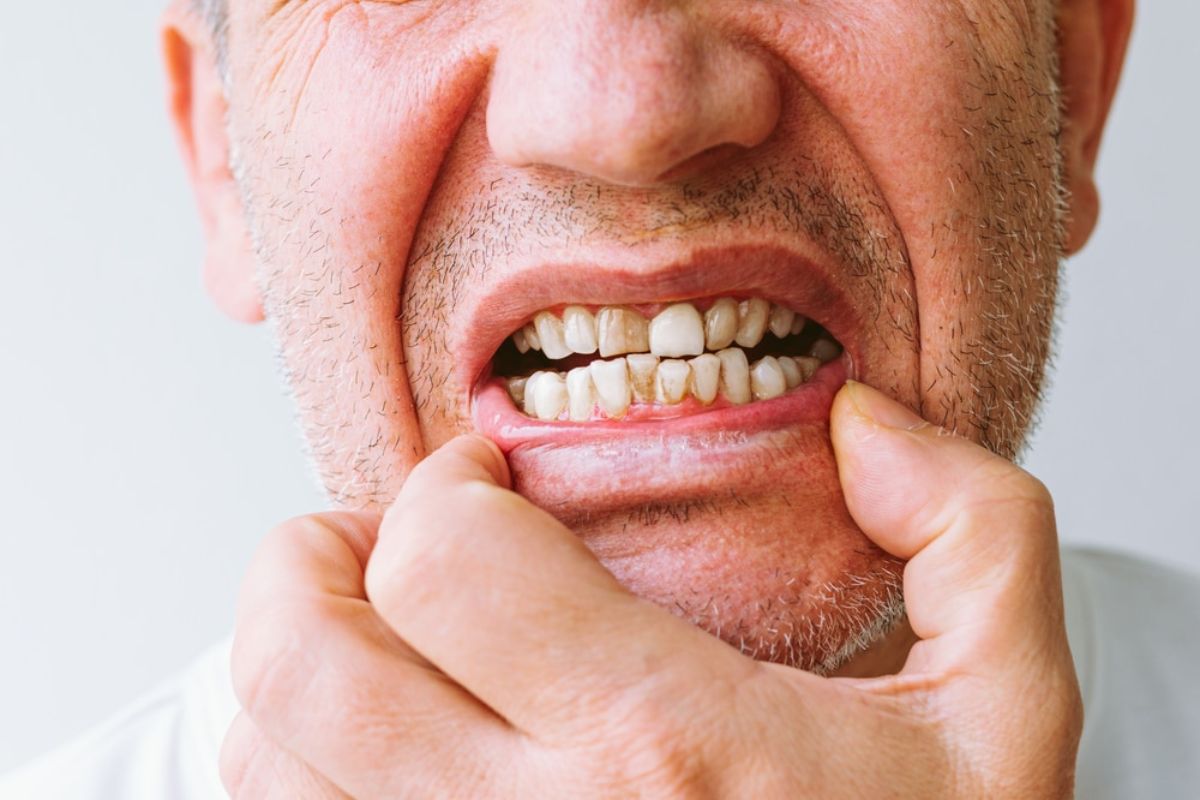 Which Stages of Gum Disease Can Be Cured?