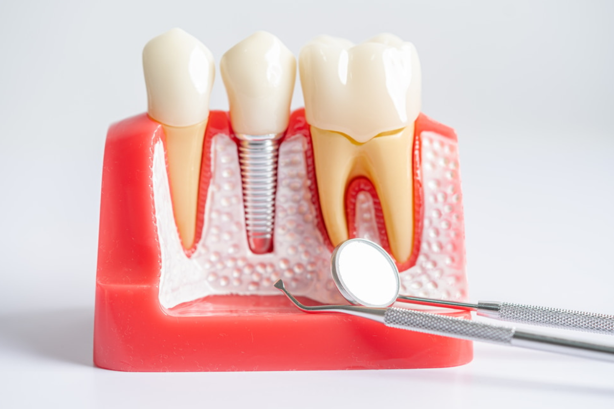 What Are Dental Implants and How Do They Work?