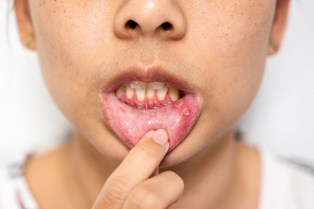 A Complete Guide to Canker Sores on Gums