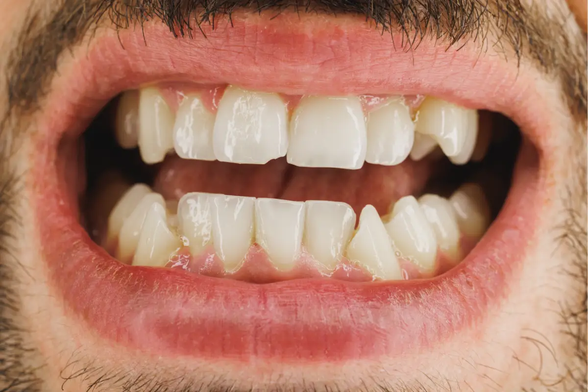 Chipped a Tooth? Here’s What to Do Before You Panic